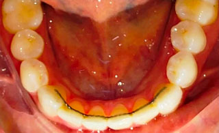 Bonded Ligual Retainer